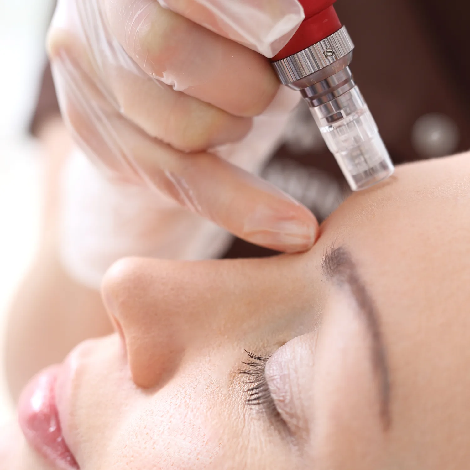 Microneedling in Petersfield: The Secret to Smoother, Brighter, Younger-Looking Skin