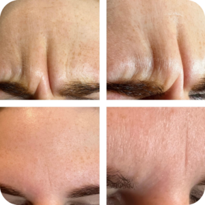 Anti Wrinkle Injections
