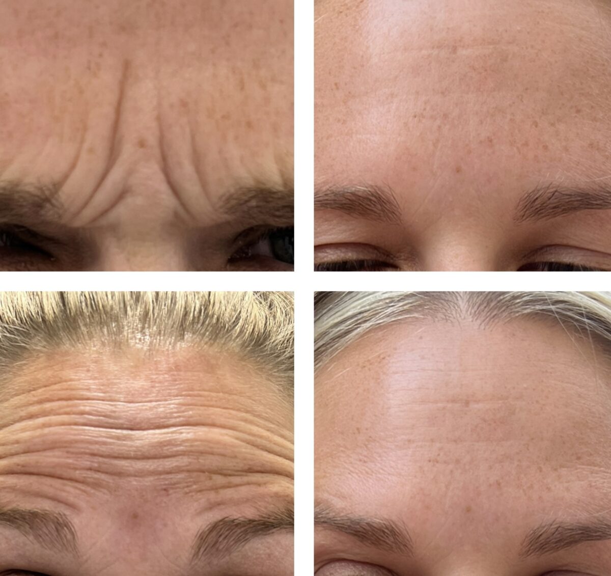 Anti-Wrinkle Injections