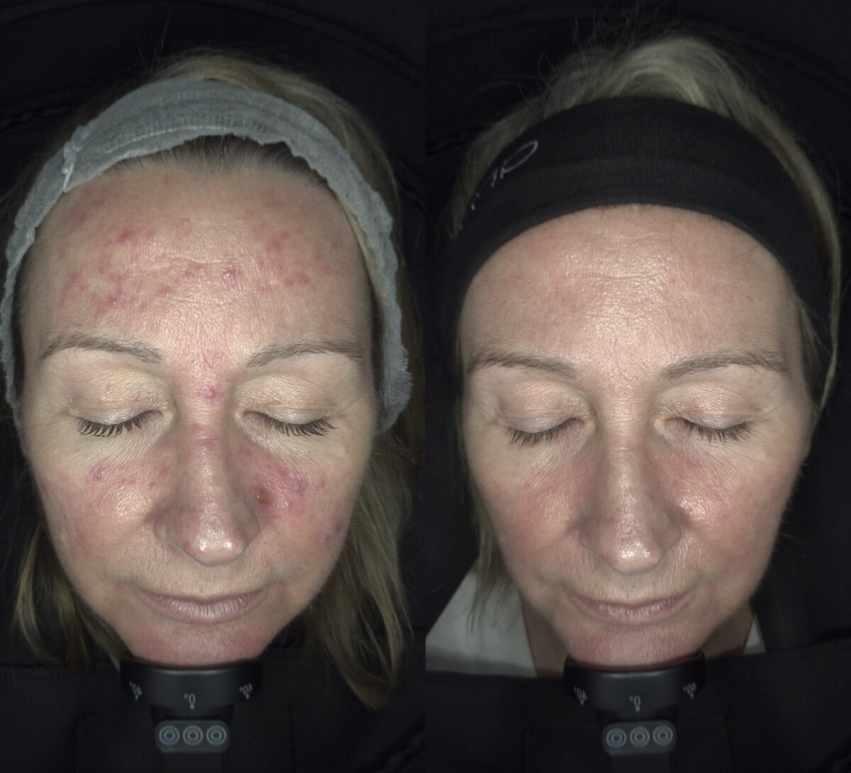 Skin Scan - Rosacea Results