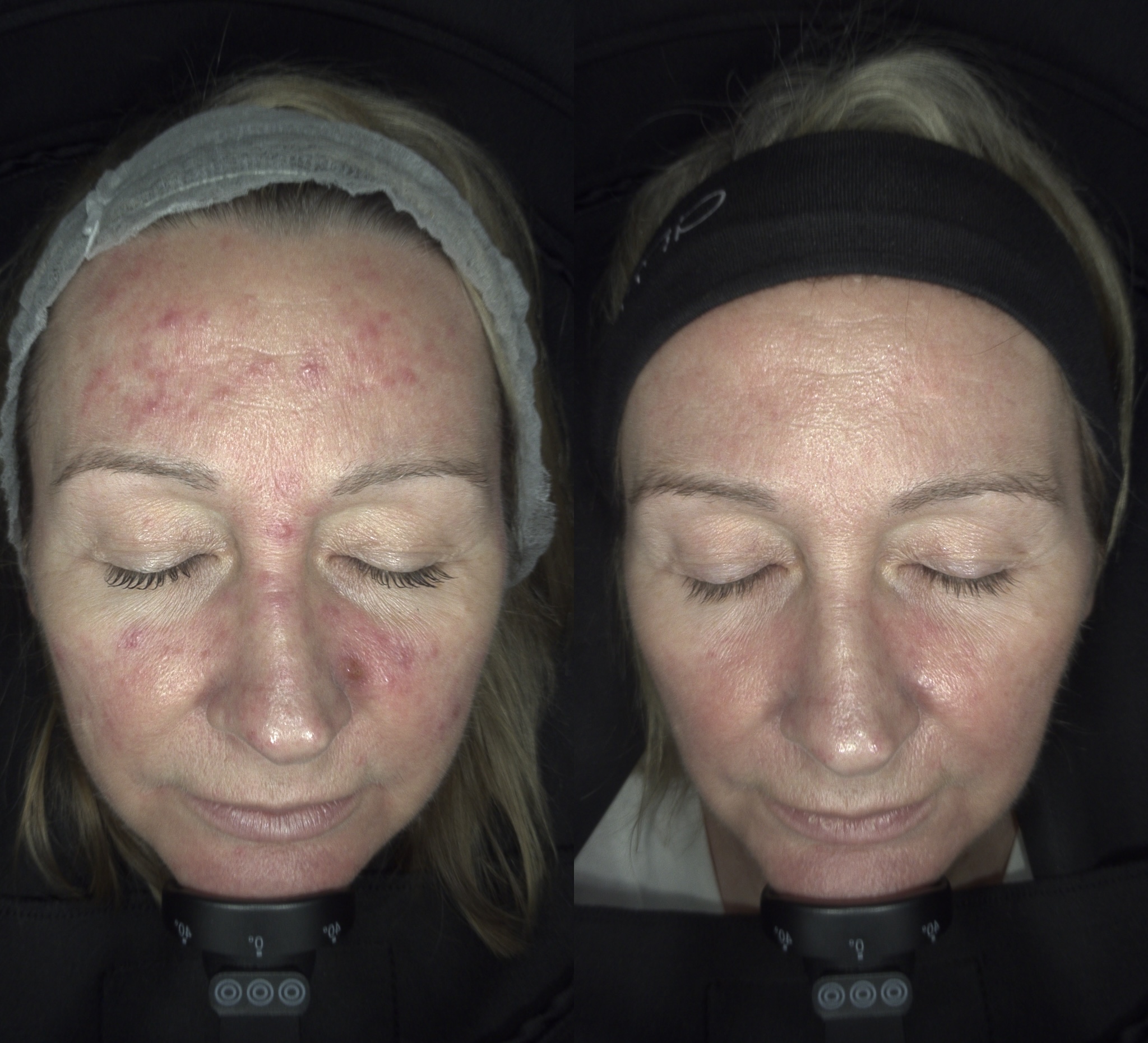 April is Rosacea Awareness Month: Understanding, Managing, and Treating Rosacea at Hampshire Dermal Aesthetics