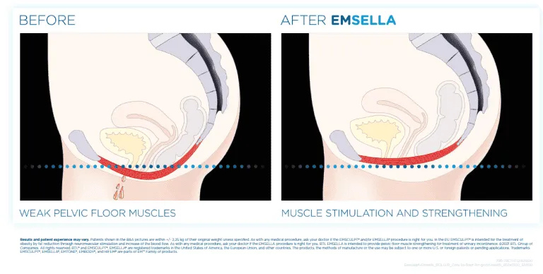 EMSELLA Chair | Pelvic Floor Treatment Device